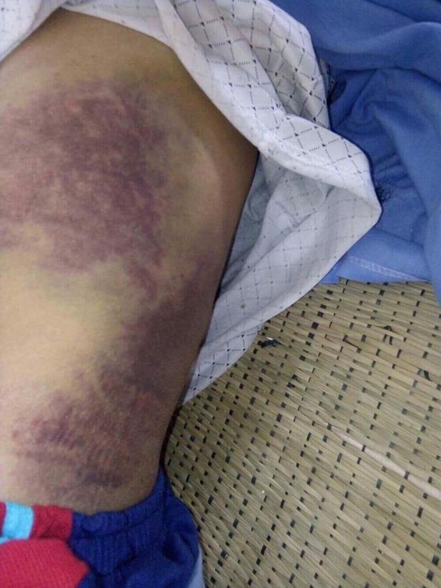 Kinh hoàng bố bị con trai đánh bầm dập, gãy xương sườn, mẻ bánh chè